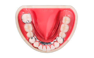 金属床義歯2