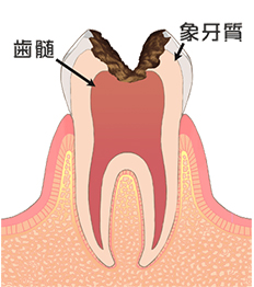 C3／神経まで進んだ虫歯（歯髄まで侵される）