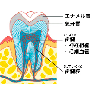 虫歯の進行度合い