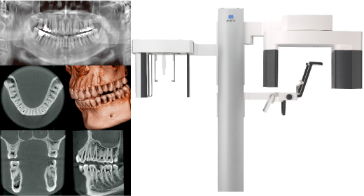 歯科用3Dデジタルレントゲン